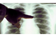  16 lei/zi, indemnizația bolnavilor de TBC care primesc tratament la domiciliu