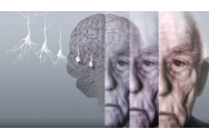 Primul pacient tratat cu noul medicament aprobat pentru Alzheimer