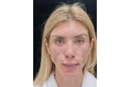 Regină a frumuseții, desfigurată de o operație estetică: „Ochii nu mi se închid și nu pot zâmbi”