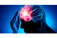 Accidentul vascular cerebral afectează 60.000 de români în fiecare an