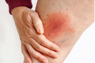 A apărut primul caz de boală Lyme, iar medicii ieșeni sunt în alertă