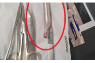 Halucinant! Un medic i-a cusut piciorul unui bărbat cu frâna de la bicicletă în interior