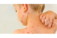 În România este epidemie de rujeolă