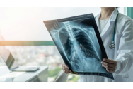 Medicii trag un semnal de alarmă: tuberculoza revine în forță!