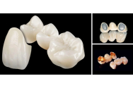  Care este diferenta dintre lucrarile dentare metalo ceramice si cele din zirconiu?