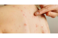 Campanie de informare privind vaccinarea împotriva rujeolei la Vaslui