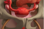 Endometrioza, boala invizibilă care schimbă vieți